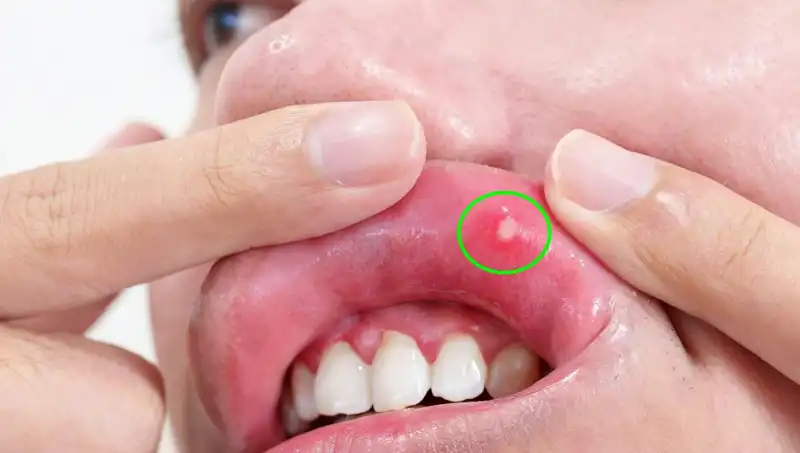 Kanserin Gizli Uyarısı: Dili Alınmak Zorunda Kaldı